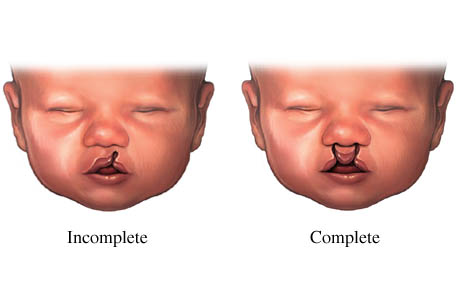 Two examples of cleft lip