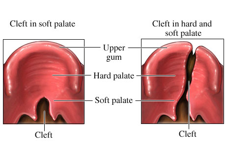 Examples of cleft palate