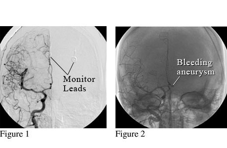 Angiogram image of the brain