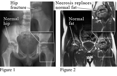 Legg-Calve-Perthes disease