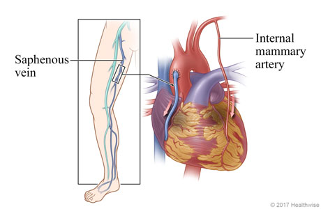 Location of saphenous vein  in leg, and heart showing saphenous  vein and an internal mammary artery used to bypass the diseased coronary artery 