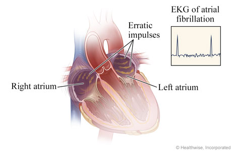 How atrial fibrillation happens