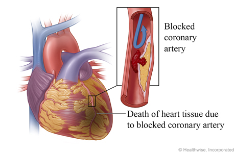 Blood clot completely  blocks coronary artery, causing a heart attack and death of heart tissue