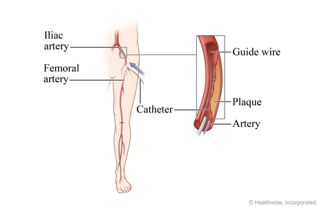 Location of the iliac artery, with detail of the catheter and guide wire inserted in the artery Location of the iliac artery, with detail of the catheter and guide wire inserted in the artery