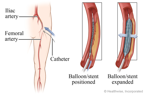 Balloon and stent positioned and expanded Balloon and stent positioned and expanded