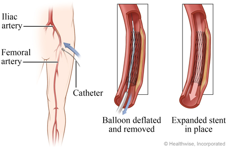 Deflated balloon removed and expanded stent in place Deflated balloon removed and expanded stent in place