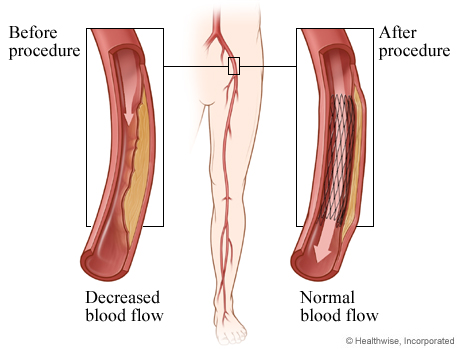 Decreased blood flow before angioplasty and normal blood flow after angioplasty Decreased blood flow before angioplasty and normal blood flow after angioplasty