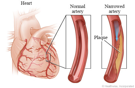 Normal  coronary artery and artery narrowed by plaque