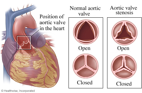 Location of aortic valve in heart with detail of normal open and closed valve and one with stenosis