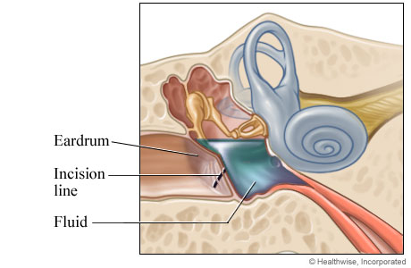 An incision made in the eardrum An incision made in the eardrum