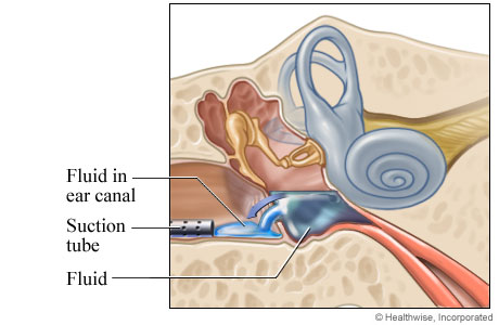 Fluid draining through the incision Fluid draining through the incision