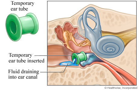 An ear tube in place and fluid draining into the ear canal An ear tube in place and fluid draining into the ear canal