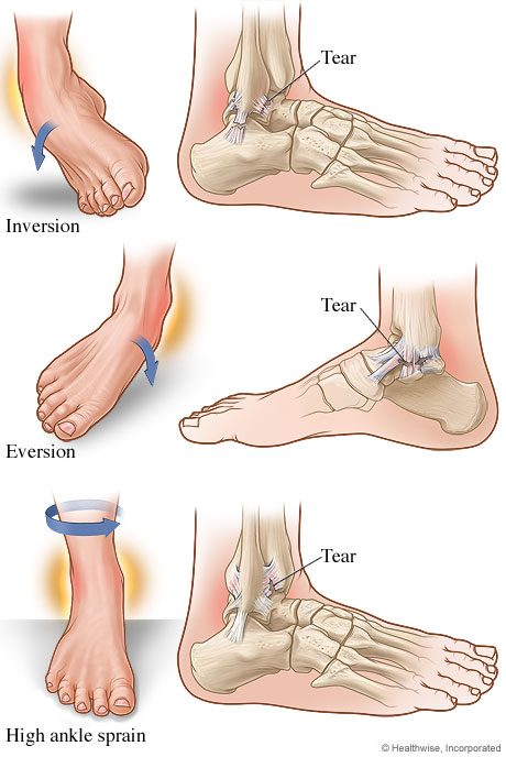 Types of ankle sprains