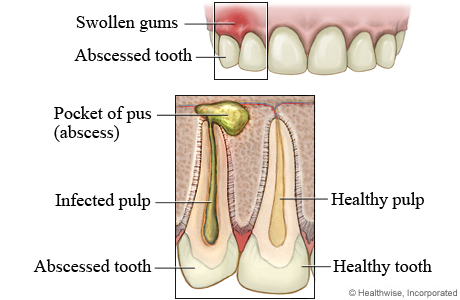 Swollen gums and  abscessed tooth, with detail of an abscessed tooth and a healthy tooth