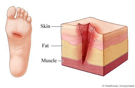 Picture of a skin laceration