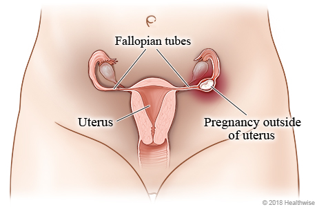 Female reproductive system, showing pregnancy outside uterus in fallopian tube