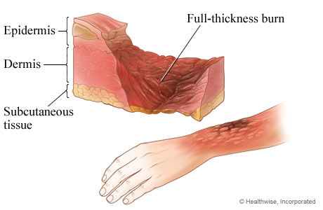 Third-degree burn: full-thickness burn