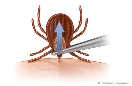 Removing a tick with tweezers