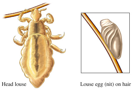 Head lice