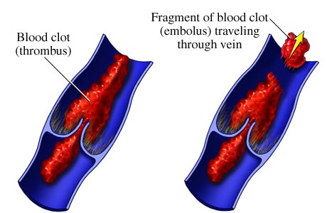 Venous thrombus and embolus