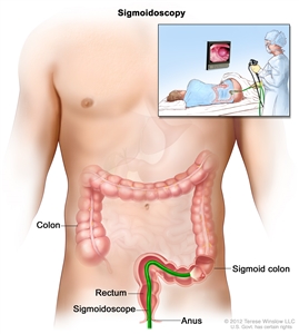 Sigmoidoscopy; shows sigmoidoscope inserted through the anus and rectum and into the sigmoid colon. Inset shows patient on table having a sigmoidoscopy.