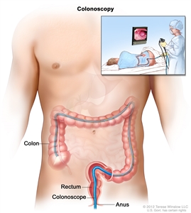 Colonoscopy; shows colonoscope inserted through the anus and rectum and into the colon. Inset shows patient on table having a colonoscopy.