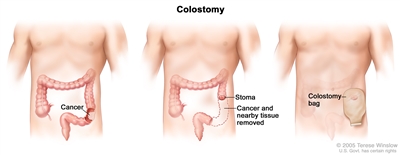 Three-panel drawing showing colon cancer surgery with colostomy; first panel shows the area of the colon with cancer, middle panel shows the cancer and nearby tissue removed and a stoma created, last panel shows a colostomy bag attached to the stoma.