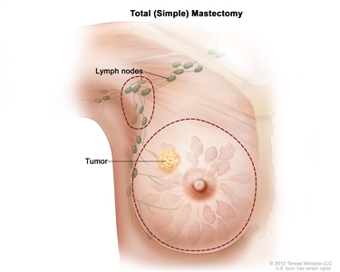 Total (simple) mastectomy; drawing shows removal of the breast and lymph nodes.