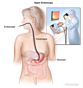 Upper endoscopy; shows endoscope inserted through the mouth and esophagus and into the stomach. Inset shows patient on table having an upper endoscopy.