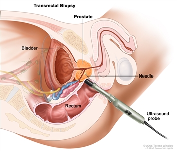 Transrectal biopsy; drawing shows a side view of the prostate, bladder, and rectum. Drawing also shows an ultrasound probe with a needle inserted into the rectum to remove a tissue sample from the prostate.