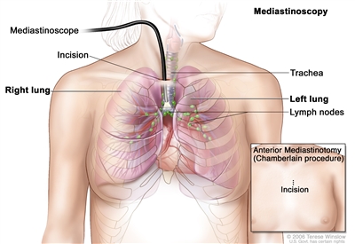 Mediastinoscopy; shows mediastinoscope with light and lens inserted into
the chest through an incision above the breastbone. Drawing shows right
and left lungs, trachea, and lymph nodes. Inset shows anterior
mediastinotomy (Chamberlain procedure) with incision beside the
breastbone.