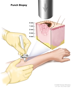 Punch biopsy; drawing shows a hollow, circular scalpel being inserted into a lesion on the skin of a patient's forearm. The instrument is turned clockwise and counterclockwise to cut into the skin and a small sample of tissue is removed to be checked under a microscope. The pullout shows that the instrument cuts down about 4 millimeters (mm) to the layer of fatty tissue below the dermis.