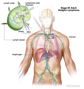 Stage IIE adult Hodgkin lymphoma; drawing shows cancer in one lymph node group above the diaphragm and in the left lung. An inset shows a lymph node with a lymph vessel, an artery, and a vein. Lymphoma cells containing cancer are shown in the lymph node.