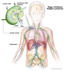 Stage I childhood Hodgkin lymphoma; drawing shows cancer in one lymph node group above the diaphragm. An inset shows a lymph node with a lymph vessel, an artery, and a vein. Lymphoma cells containing cancer are shown in the lymph node.