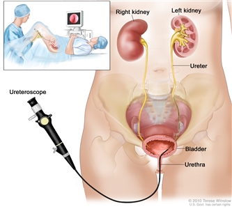 Ureteroscopy; drawing shows the lower pelvis containing the right and left kidneys, ureter, bladder, and urethra. The flexible tube of a ureteroscope (a thin, tube-like instrument with a light and a lens for viewing) is shown passing through the urethra into the bladder and ureter. An inset shows a woman lying on an examination table with her knees bent and legs apart. She is covered by a drape. The doctor looks at an image of the inside of the ureter on a computer monitor.