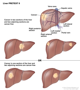 Liver PRETEXT II; drawing shows five livers. Dotted lines divide each liver into four vertical sections that are about the same size. In the first liver, cancer is shown in the two sections on the left. In the second liver, cancer is shown in the two sections on the right. In the third liver, cancer is shown in the far left and far right sections. In the fourth liver, cancer is shown in the second section from the left. In the fifth liver, cancer is shown in the second section from the right.