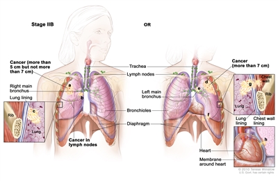 Two-panel drawing of stage IIB non-small cell lung cancer. First panel shows cancer (more than 5 cm but not more than 7 cm), and cancer in the right main bronchus and lymph nodes; also shown are the trachea, bronchioles, and diaphragm. Inset shows cancer that has spread from the lung to the innermost layer of the lung lining; a rib is also shown. Second panel shows cancer (more than 7 cm), and cancer in the left main bronchus; also shown are the trachea, lymph nodes, bronchioles, and diaphragm. Top inset shows cancer that has spread from the lung through the lung lining and chest wall lining into the chest wall; a rib is also shown. Bottom inset shows the heart and cancer that has spread from the lung into the membrane around the heart.