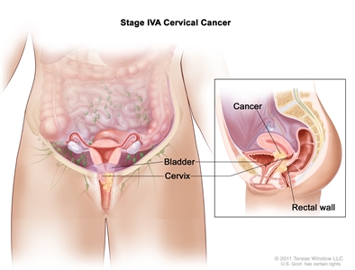 Stage IVA cervical cancer; drawing and inset show that cancer has spread from the cervix to the bladder and rectal wall.