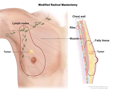 Modified radical mastectomy. The drawing on the left shows the removal of the breast, most or all of the lymph nodes under the arm, the lining over the chest muscles and sometimes part of the chest wall muscles. The drawing on the right shows a cross-section of the breast including the chest wall (ribs and muscle), fatty tissue, and the tumor.