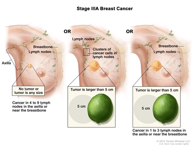 Stage IIIA breast cancer. The drawing on the left shows no tumor in the breast; cancer is found in 8 axillary lymph nodes. The drawing in the middle shows the tumor is larger than 5 cm and small clusters of cancer cells are in the lymph nodes. The drawing on the right shows the tumor is larger than 5 cm and cancer is in 3 axillary lymph nodes.