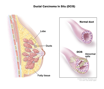 Ductal carcinoma in situ (DCIS); drawing shows a lobe, ducts, and fatty tissue in a cross section of the breast. The inset shows a normal duct and a duct with abnormal cells.