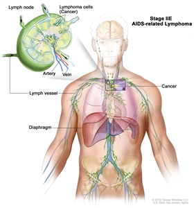 Stage IIE AIDS-related lymphoma; drawing shows cancer in one lymph node group above the diaphragm and in the left lung. An inset shows a lymph node with a lymph vessel, an artery, and a vein. Lymphoma cells containing cancer are shown in the lymph node.