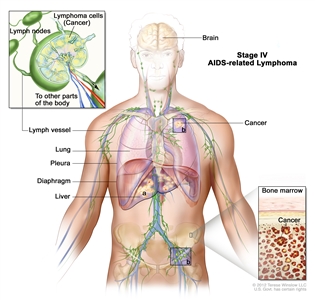 Stage IV AIDS-related lymphoma; drawing shows cancer in the liver, the left lung, and in one lymph node group below the diaphragm. The brain and pleura are also shown. One inset shows a close-up of cancer spreading through lymph nodes and lymph vessels to other parts of the body. Lymphoma cells containing cancer are shown inside one lymph node. Another inset shows cancer cells in the bone marrow.