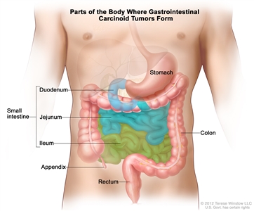 Parts of the body where gastrointestinal carcinoid tumors form; drawing of the gastrointestinal tract showing the stomach, small intestine (including the duodenum, jejunum, and ileum), appendix, colon, and rectum.