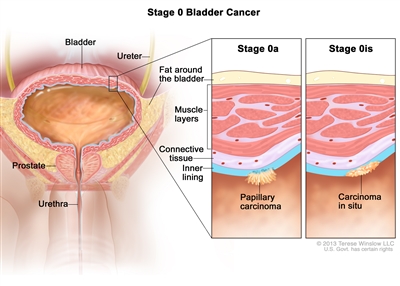 Stage 0 bladder cancer; drawing shows the bladder, ureter, prostate, and urethra. First inset shows stage 0a (also called noninvasive papillary carcinoma) on the inner lining of the bladder. Second inset shows stage 0is (also called carcinoma in situ) on the inner lining of the bladder. Also shown are the layers of connective tissue and muscle tissue of the bladder and the layer of fat around the bladder.