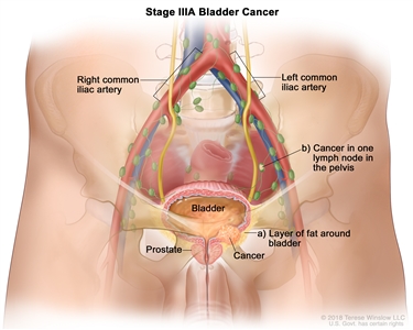 Stage IIIA bladder cancer; drawing shows cancer in the bladder and in (a) the layer of fat around the bladder and (b) one lymph node in the pelvis. Also shown are the right and left common iliac arteries and the prostate.