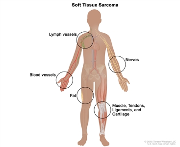 Soft tissue sarcoma; drawing shows different types of tissue in the body where soft tissue sarcomas form, including the lymph vessels, blood vessels, fat, muscles, tendons, ligaments, cartilage, and nerves.