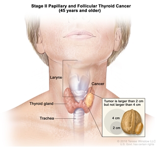 Stage II papillary and follicular thyroid cancer in patients 45 years and older; drawing shows cancer in the thyroid gland. The tumor is larger than 2 centimeters but not larger than 4 centimeters. Also shown are the larynx and trachea.