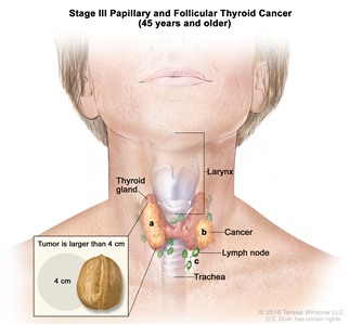 Stage III papillary and follicular thyroid cancer in patients 45 years and older; drawing shows (a) cancer in the thyroid gland and the tumor is larger than 4 centimeters; (b) cancer has spread to tissues just outside the thyroid gland; and (c) cancer has spread to lymph nodes near the trachea. Also shown is the larynx.