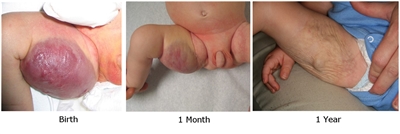 Photographs showing a cutaneous congenital hemangioma on the inner right thigh at birth (left panel), 1 month (middle panel), and 1 year (right panel).